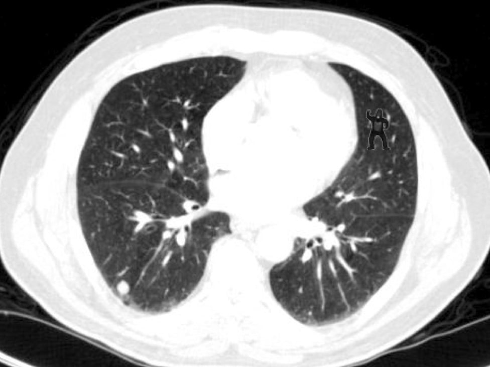 Lung Xray